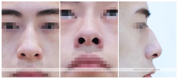 남자 매부리코 교정 전후사진 : 크고 휜 남자코 무보형물 매부리코 수술 수술 기록 사진