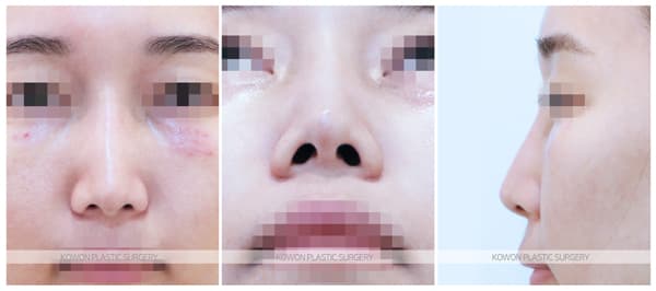 베이코제거, 미스코제거 후 코재수술 : 코 안의 이물질제거후 코수술을 하신 경우 수술 기록 사진