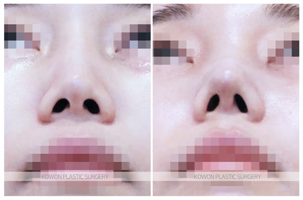 베이코제거, 미스코제거 후 코재수술 : 코 안의 이물질제거후 코수술을 하신 경우 수술 기록 사진