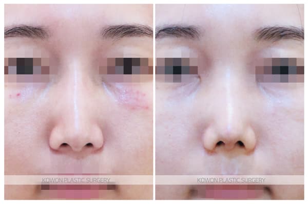 베이코제거, 미스코제거 후 코재수술 : 코 안의 이물질제거후 코수술을 하신 경우 수술 기록 사진