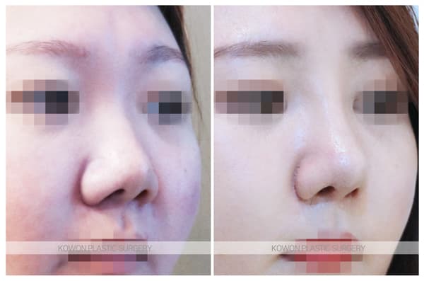 ภาพบันทึกการผ่าตัด 짧은 들창코 전후사진 : 복코, 짧은코 비중격연장과 콧날개축소를 함께 한 경우