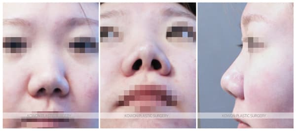 짧은 들창코 전후사진 : 복코, 짧은코 비중격연장과 콧날개축소를 함께 한 경우 수술 기록 사진