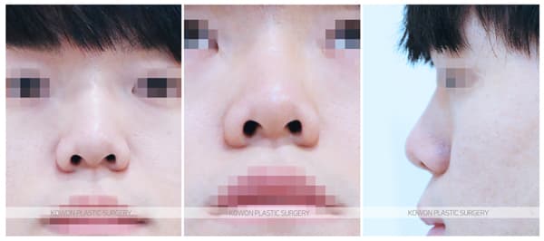 남자코성형 전후사진 : 자연스러운 직선코 남자코수술 수술 기록 사진