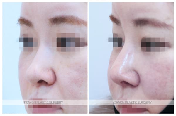 ภาพบันทึกการผ่าตัด 양악후코성형 전후사진 : 늑연골 코수술 , 늑입자 코성형(자가조직코성형)
