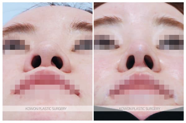 ภาพบันทึกการผ่าตัด 양악후코성형 전후사진 : 늑연골 코수술 , 늑입자 코성형(자가조직코성형)