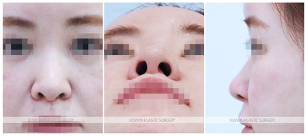 양악후코성형 전후사진 : 늑연골 코수술 , 늑입자 코성형(자가조직코성형) 수술 기록 사진
