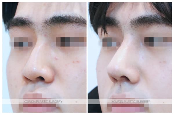 남자 매부리코 수술전후사진 : 매부리절골술, 코끝연골묶기로 매끄러운 느낌의 남자코 수술 기록 사진
