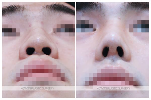 남자 매부리코 수술전후사진 : 매부리절골술, 코끝연골묶기로 매끄러운 느낌의 남자코 수술 기록 사진