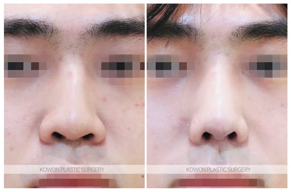 남자 매부리코 수술전후사진 : 매부리절골술, 코끝연골묶기로 매끄러운 느낌의 남자코 수술 기록 사진