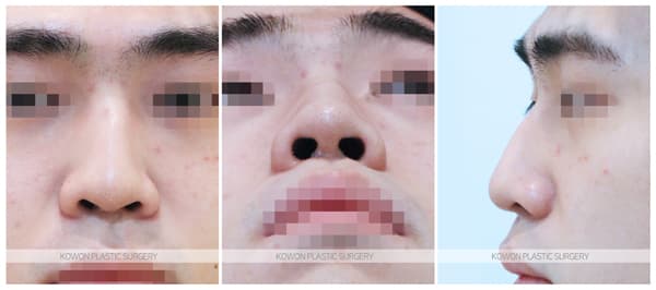 남자 매부리코 수술전후사진 : 매부리절골술, 코끝연골묶기로 매끄러운 느낌의 남자코 수술 기록 사진