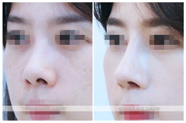 ภาพบันทึกการผ่าตัด 짧은코, 들창코 전후사진 : 비중격연장술, 비대칭콧구멍 교정