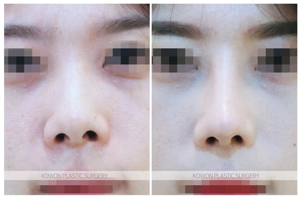ภาพบันทึกการผ่าตัด 짧은코, 들창코 전후사진 : 비중격연장술, 비대칭콧구멍 교정