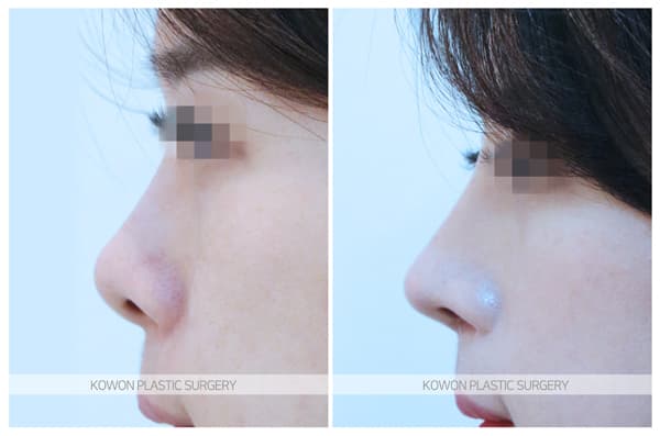 ภาพบันทึกการผ่าตัด 짧은코, 들창코 전후사진 : 비중격연장술, 비대칭콧구멍 교정