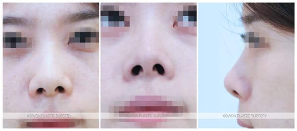 짧은코, 들창코 전후사진 : 비중격연장술, 비대칭콧구멍 교정 수술 기록 사진