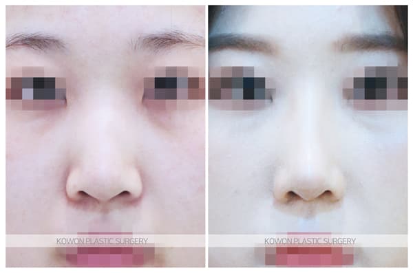 ภาพบันทึกการผ่าตัด 긴코 수술전후사진 : 코끝내림근제거, 매부리코 제거 높고 화려한 코로