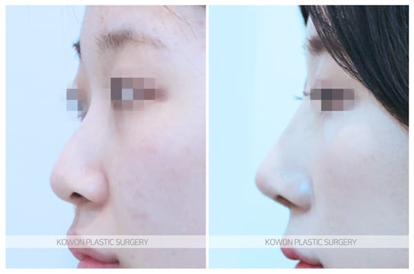 ภาพบันทึกการผ่าตัด 긴코 수술전후사진 : 코끝내림근제거, 매부리코 제거 높고 화려한 코로