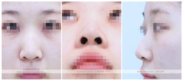 긴코 수술전후사진 : 코끝내림근제거, 매부리코 제거 높고 화려한 코로 수술 기록 사진
