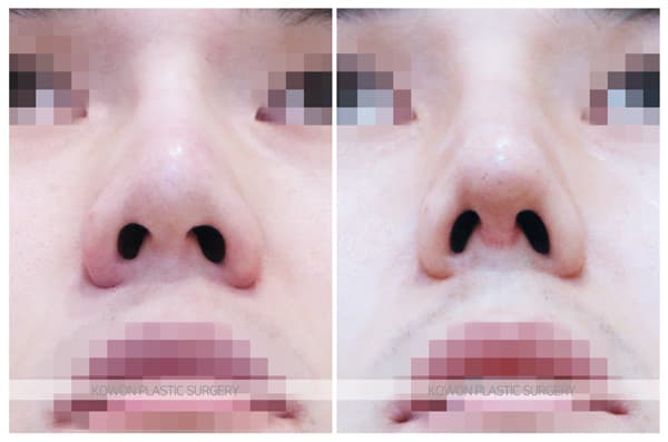 베이코제거 후 남자코재수술 전후사진 : 이물질제거 후 남자코수술 수술 기록 사진