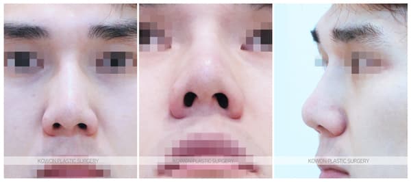 베이코제거 후 남자코재수술 전후사진 : 이물질제거 후 남자코수술 수술 기록 사진