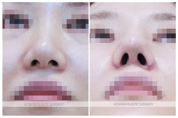 코원성형외과 여자복코 수술전후사진 : 복코는 얼마나 작고 날렵하게 바뀔 수 있을까? 수술 기록 사진