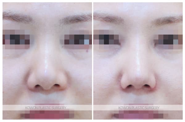 코원성형외과 여자복코 수술전후사진 : 복코는 얼마나 작고 날렵하게 바뀔 수 있을까? 수술 기록 사진