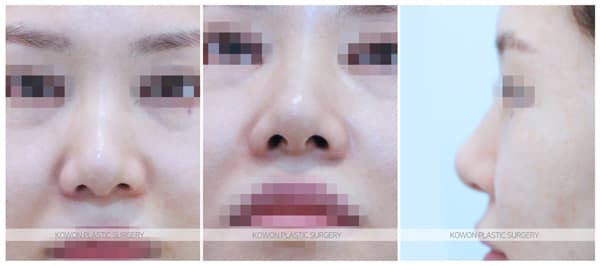 코원성형외과 여자복코 수술전후사진 : 복코는 얼마나 작고 날렵하게 바뀔 수 있을까? 수술 기록 사진
