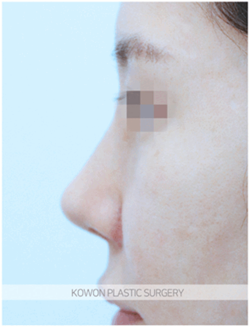 코원성형외과 여자복코 수술전후사진 : 복코는 얼마나 작고 날렵하게 바뀔 수 있을까? 수술 기록 사진