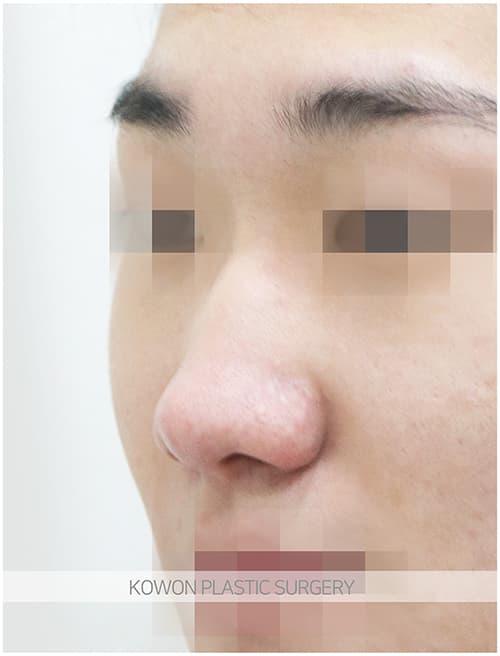 코원성형외과 남자 복코 남자 직선코 되고싶어요. 콧볼축소도 필요한가요? 수술 기록 사진