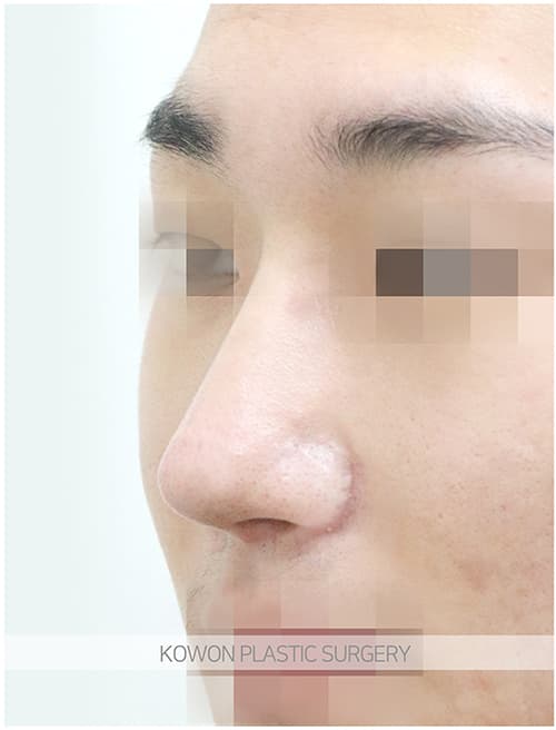 코원성형외과 남자 복코 남자 직선코 되고싶어요. 콧볼축소도 필요한가요? 수술 기록 사진