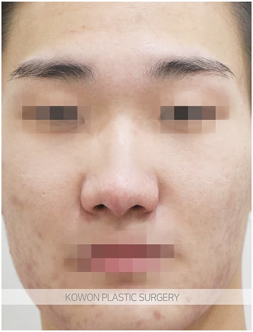 코원성형외과 남자 복코 남자 직선코 되고싶어요. 콧볼축소도 필요한가요? 수술 기록 사진