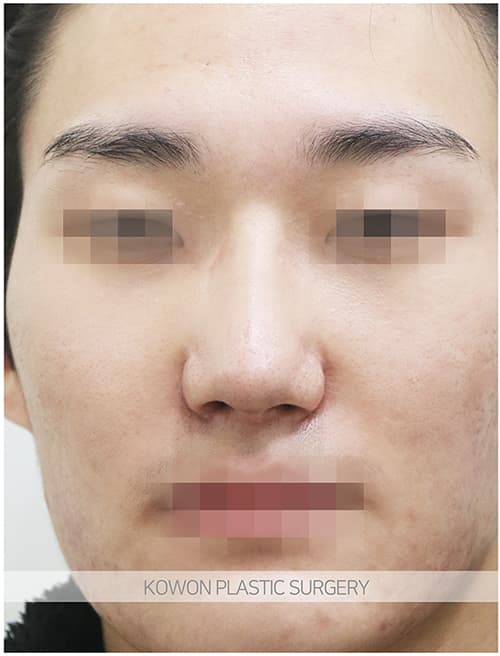 코원성형외과 남자 복코 남자 직선코 되고싶어요. 콧볼축소도 필요한가요? 수술 기록 사진