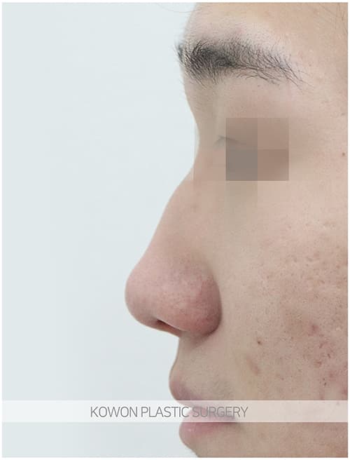 코원성형외과 남자 복코 남자 직선코 되고싶어요. 콧볼축소도 필요한가요? 수술 기록 사진
