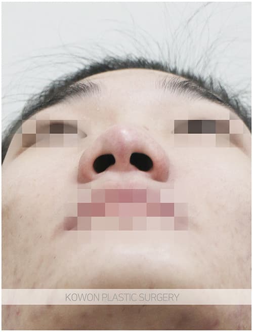 코원성형외과 남자 복코 남자 직선코 되고싶어요. 콧볼축소도 필요한가요? 수술 기록 사진