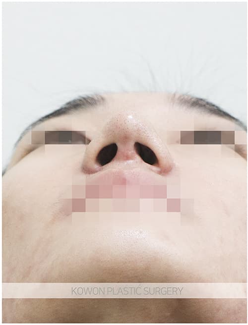 코원성형외과 남자 복코 남자 직선코 되고싶어요. 콧볼축소도 필요한가요? 수술 기록 사진
