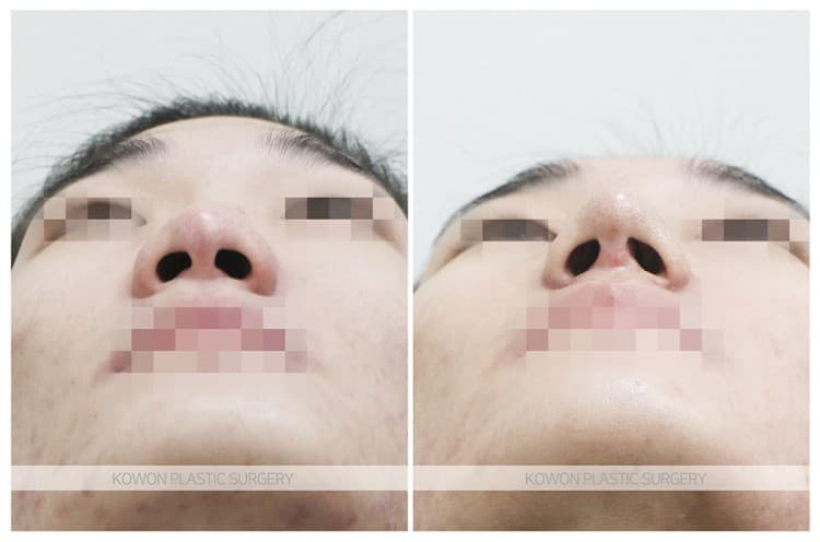 코원성형외과 남자 복코 남자 직선코 되고싶어요. 콧볼축소도 필요한가요? 수술 기록 사진