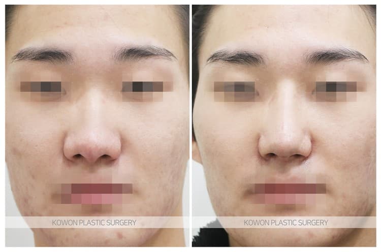 코원성형외과 남자 복코 남자 직선코 되고싶어요. 콧볼축소도 필요한가요? 수술 기록 사진