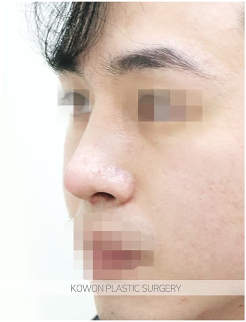 남자매부리코성형 자연스럽고 확실한 변화로 남자코끝성형 원한다면 수술 기록 사진