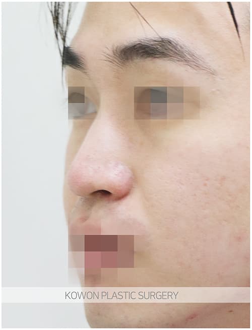 남자매부리코성형 자연스럽고 확실한 변화로 남자코끝성형 원한다면 수술 기록 사진