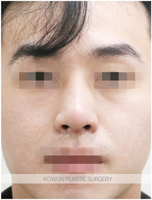 남자매부리코성형 자연스럽고 확실한 변화로 남자코끝성형 원한다면 수술 기록 사진