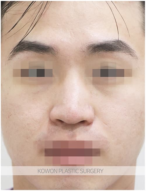 남자매부리코성형 자연스럽고 확실한 변화로 남자코끝성형 원한다면 수술 기록 사진
