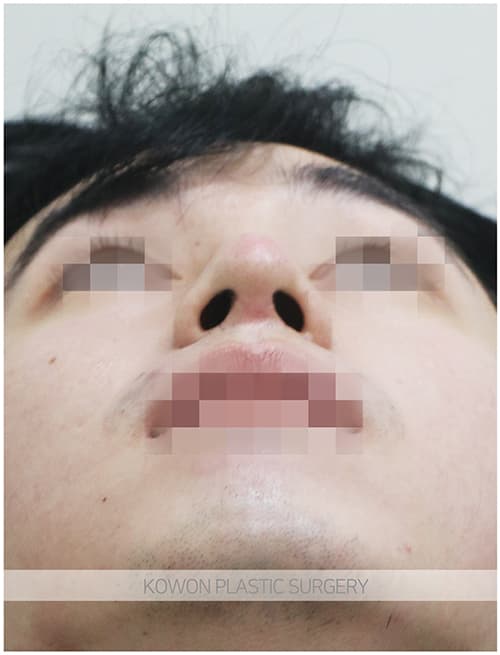 남자매부리코성형 자연스럽고 확실한 변화로 남자코끝성형 원한다면 수술 기록 사진