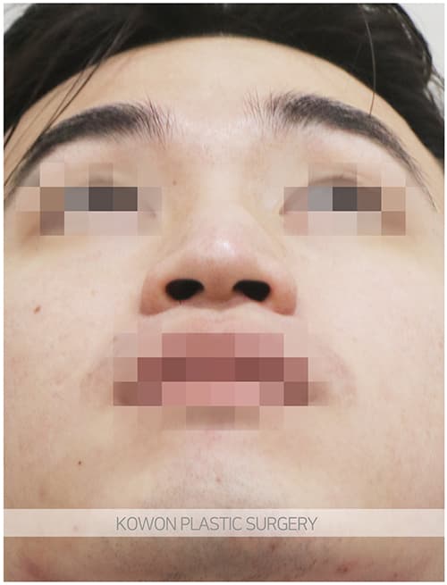 남자매부리코성형 자연스럽고 확실한 변화로 남자코끝성형 원한다면 수술 기록 사진