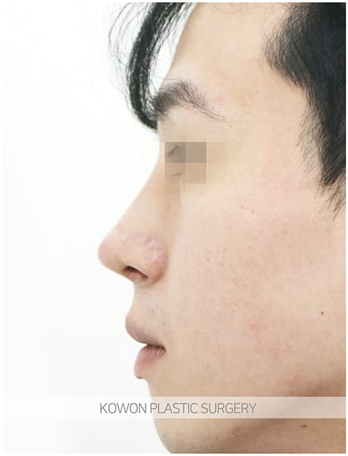 남자매부리코성형 자연스럽고 확실한 변화로 남자코끝성형 원한다면 수술 기록 사진