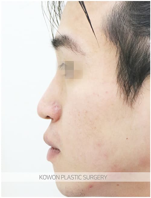 남자매부리코성형 자연스럽고 확실한 변화로 남자코끝성형 원한다면 수술 기록 사진