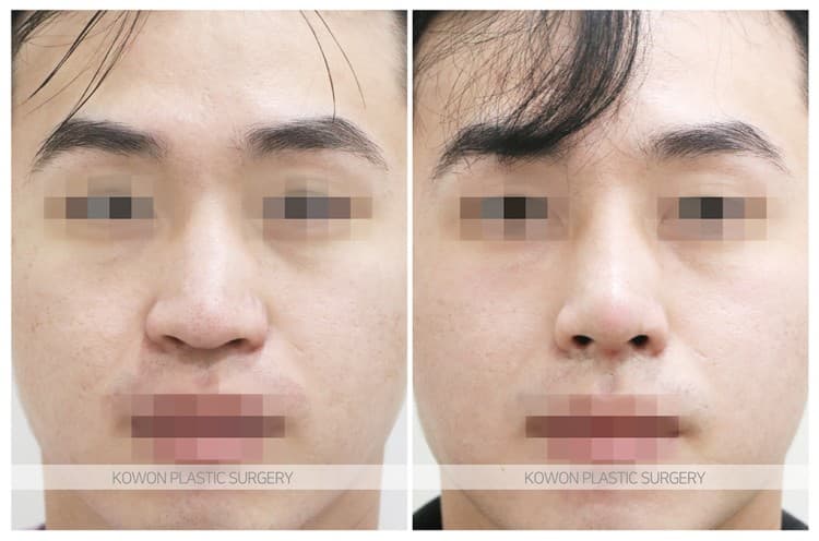 남자매부리코성형 자연스럽고 확실한 변화로 남자코끝성형 원한다면 수술 기록 사진