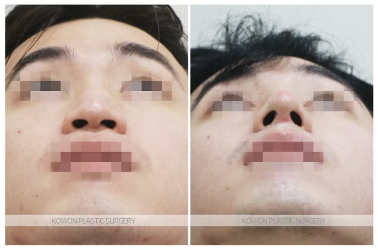 남자매부리코성형 자연스럽고 확실한 변화로 남자코끝성형 원한다면 수술 기록 사진
