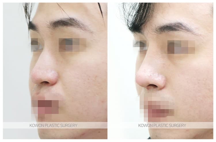 남자매부리코성형 자연스럽고 확실한 변화로 남자코끝성형 원한다면 수술 기록 사진