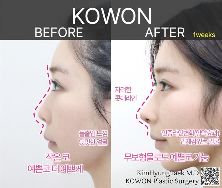무보형물 코수술로도 오똑하고 예쁜 코 라인이 되는 경우 수술 기록 사진