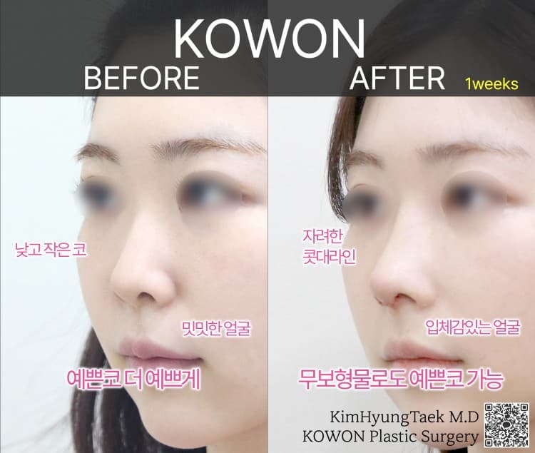 무보형물 코수술로도 오똑하고 예쁜 코 라인이 되는 경우 수술 기록 사진