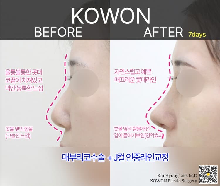 매부리코이면서 뭉툭한 복코, 전체적인 밸런스를 맞추는 포인트는? 수술 기록 사진